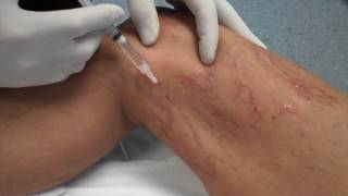 Sclerotherapy  The Vein Centre  Dr Richard Murbach  Treatment for Spider Veins [upl. by Litnahc]