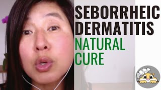 Treat Seborrheic Dermatitis Naturally  3 simple tips [upl. by Juli]