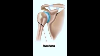 Fisioterapia quotFractura de Humeroquot [upl. by Aimej955]