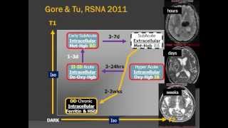 Brain Blood Clots  Imaging Hemorrhage on MR and CT [upl. by Niak]