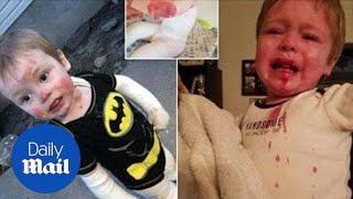 Boy has genetic disorder causing his skin to blister when touched [upl. by Steel]