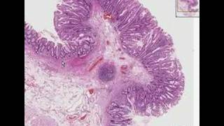 Histopathology ColonHyperplastic polyp [upl. by Marge372]