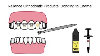 Bonding to Enamel [upl. by Beaston]