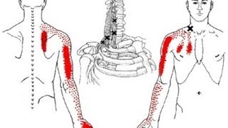 Shoulder Arm Hand and Scapula Pain from Scalene Muscle Trigger Points Referred Pain Patterns [upl. by Casey]