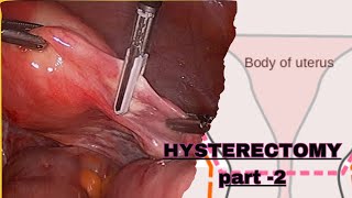 PART  2  NURSING CARE PLAN OF HYSTERECTOMY POST OPERATIVE MANAGEMENT GYNECOLOGICAL NURSING [upl. by Ynavoj]