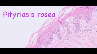 Pityriasis rosea [upl. by Sherry]