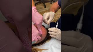 Treating Bulging Forehead Veins [upl. by Korrie]