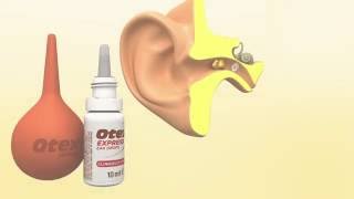 Mans Impacted Earwax Removed without Applying Earwax Softener [upl. by Hanni]