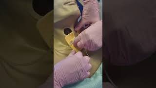 Change of tracheostomy dressing and inner tube [upl. by Adnarem]