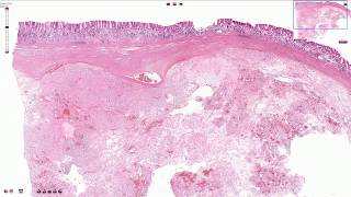 Gastrointestinal Stromal Tumor GIST  Histopathology [upl. by Elleahcim465]