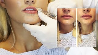 Lip Filler Experience  Start to Finish with 1 Syringe of Juvederm [upl. by Ferri]