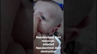 Nasolacrimal duct massageinfected Nasolacrimal duct obstruction Dr Hunar Jamal [upl. by Anomer899]