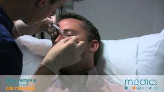 MOLE REMOVAL BY LASER SURGERY [upl. by Enilatan]