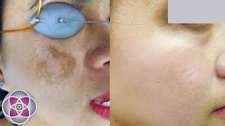 Laser Melasma amp Hyperpigmentation Treatment [upl. by Siroved15]