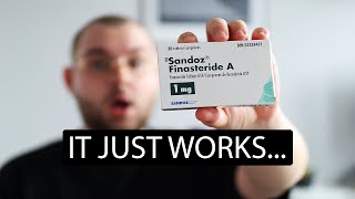 1 Year On Finasteride Heres What Happened To My Hair Finasteride Results After 1 Year [upl. by Hnad]