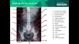 Radiografia do Abdome AP  Decúbito [upl. by Nilreb]