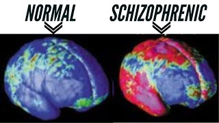 Schizophrenia Symptoms  Causes  Diagnosis  Treatment [upl. by Adnuhs]