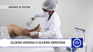 ÚLCERA VENOSA O ÚLCERA VARICOSA [upl. by Ahtnamas]