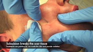 Subscision and surgery for acne scars [upl. by Oicatsana]