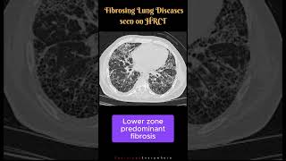 Fibrosing Lung Diseases seen on HRCT Differential Diagnosis UIP NSIP DIP shorts [upl. by Dwain301]