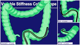 COLONOSCOPY Olympus Total [upl. by Adne688]