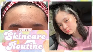 how to get rid of tiny bumps on forehead my skincare routine ❀  Philippines [upl. by Edrei]