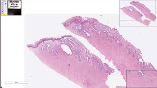 Metaplasia Escamosa no Útero  Patologia Geral [upl. by Eelegna]