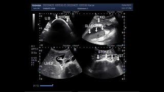 Pyelonephritis with multiple renal stones a large vesical stone in a patient aged about 26 years [upl. by Stilla]