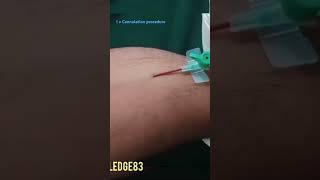 I v Cannulation procedureCannula no 18Gvideoshortvideo [upl. by Wil717]