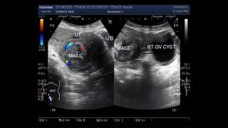 Ultrasound Video showing Fibroid with Ovarian Cyst [upl. by Alwin]