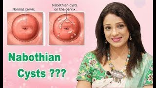 What are Nabothian cyst [upl. by Eserehc]