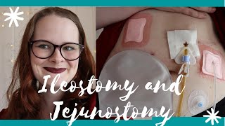 I had Ileostomy and Jejunostomy Surgery During a Pandemic [upl. by Afrika950]