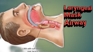 Laryngeal Mask AirwayLMA [upl. by Senilec]