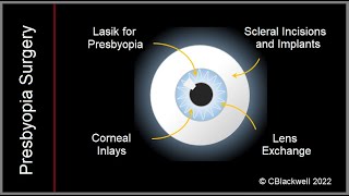 Presbyopia 3 New Treatments with Surgery [upl. by Straus]