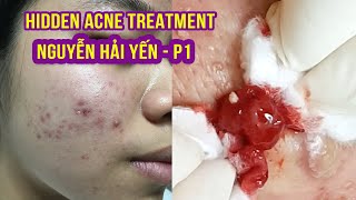 Hidden Acne I Điều trị mụn hiệu quả số 1 tại Hiền Vân Spa INguyễn Hải Yến IPart 1I 515 [upl. by Leesa]