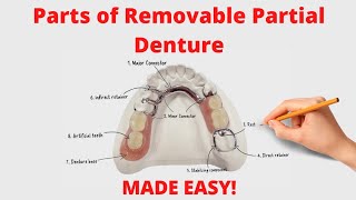 Parts of Removable Partial Denture Cast Partial Denture [upl. by Henley]