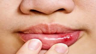 Difference Between Cold Sore and Herpes [upl. by Bullen]