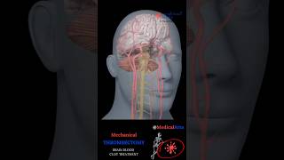 Neuro Thrombectomy Procedure with 3D Revascularization Device [upl. by Gerrard]