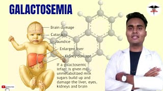 WHAT IS GALACTOSEMIA   CLINICAL ASPECTS  DIAGNOSIS  ENZYME DEFICIENT  TREATMENT [upl. by Luanne]