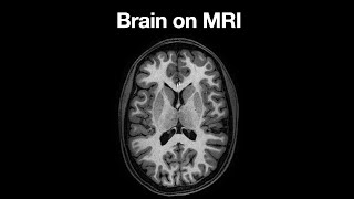 Anatomy of the Brain on MRI [upl. by Inverson]