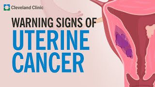 The Most Common Warning Sign of Uterine Cancer [upl. by Ehcropal742]