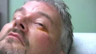 Chalazion Injection Demonstration [upl. by Yentruoc]