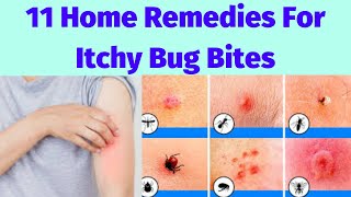 11 Home Remedies For Itchy Bug Bites [upl. by Yenwat]