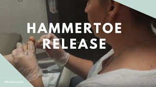 Hammertoe Tendon Release [upl. by Evita38]