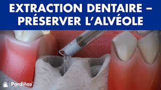 Extraction dentaire – Traitement pour préserver l’alvéole © [upl. by Yromas672]