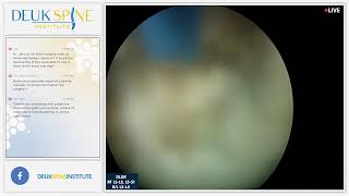 Watch Live Back Treatment Deuk Laser Disc Repair  Lumbar  Right RT L2L3 L5S1 amp BL L3L4 [upl. by Eybba]