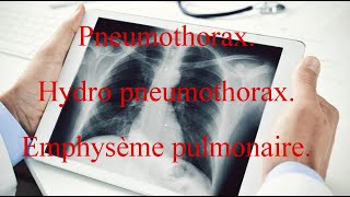 Pneumothorax  Hydro pneumothorax  Emphysème pulmonaire [upl. by Aihsenyt]