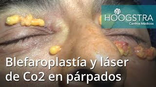 Blefaroplastía y láser de Co2 en párpados 18010 [upl. by Nodnerb486]