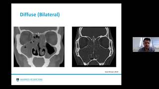 Rhinosinusitis EPOS 2020 Update [upl. by Drummond296]