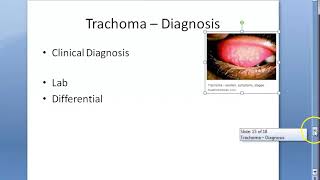 Ophthalmology 076 e Trachoma Lab Diagnosis Differential Differentiate from Viral and Vernal [upl. by Mona]